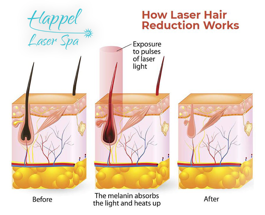 Laser hair removal process